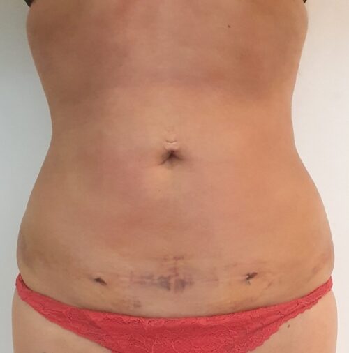 liposukcja-brzucha-kobieta-zdjecia-przed-po