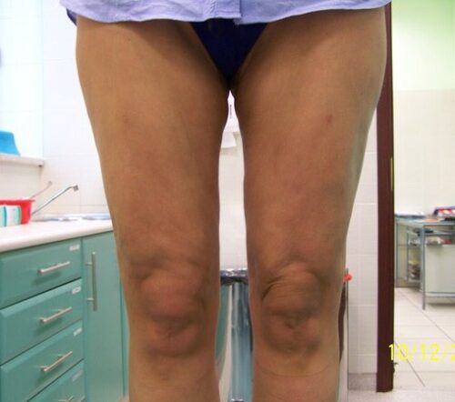 liposukcja-nogi-zdjecia-przed-po