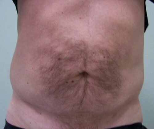 liposukcja-zdjecia-brzucha-mezczyzna-przed-po
